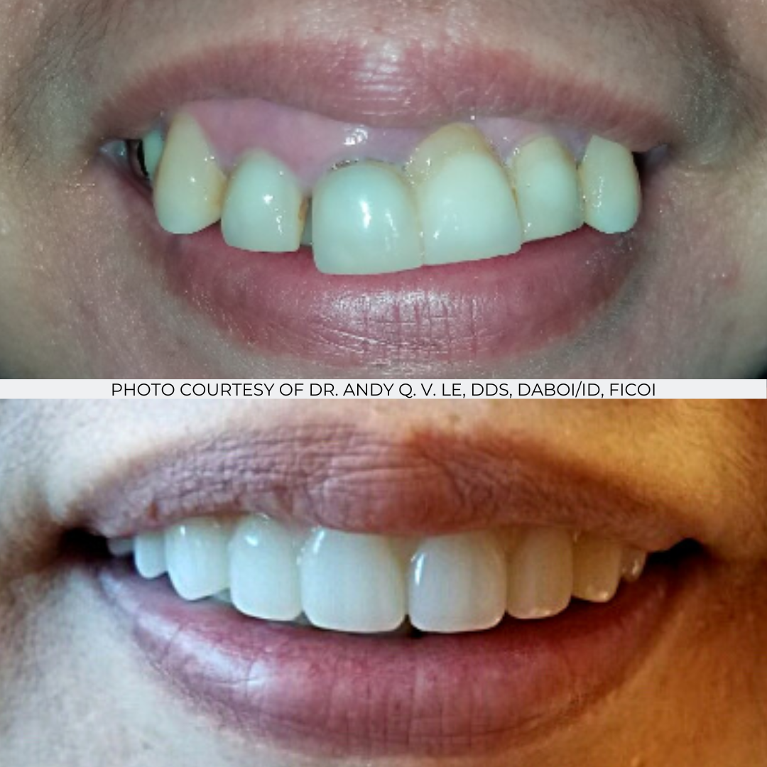 Before and After Implant Pictures